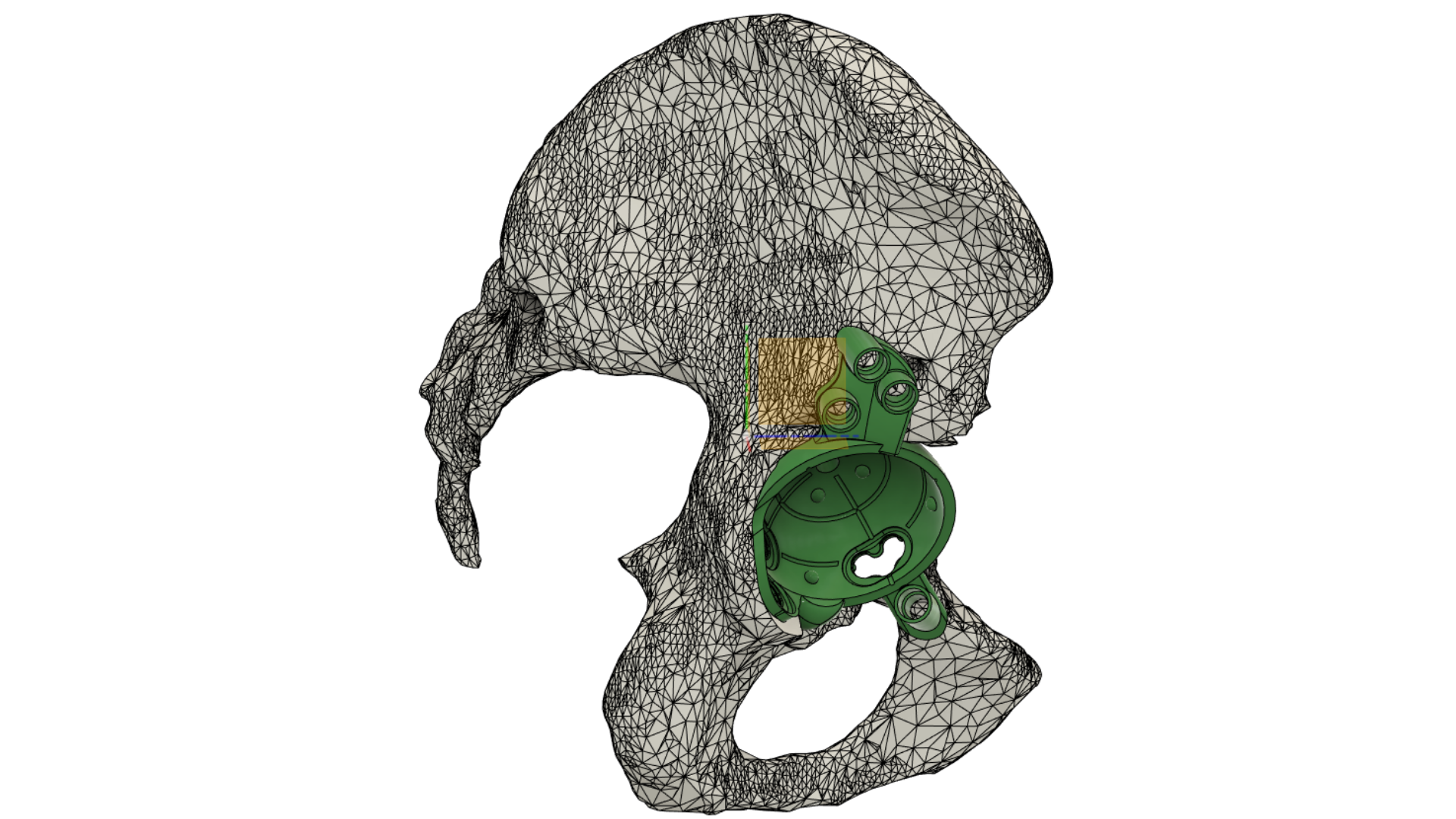 Ревізійне ендопротезування кульшового суглоба